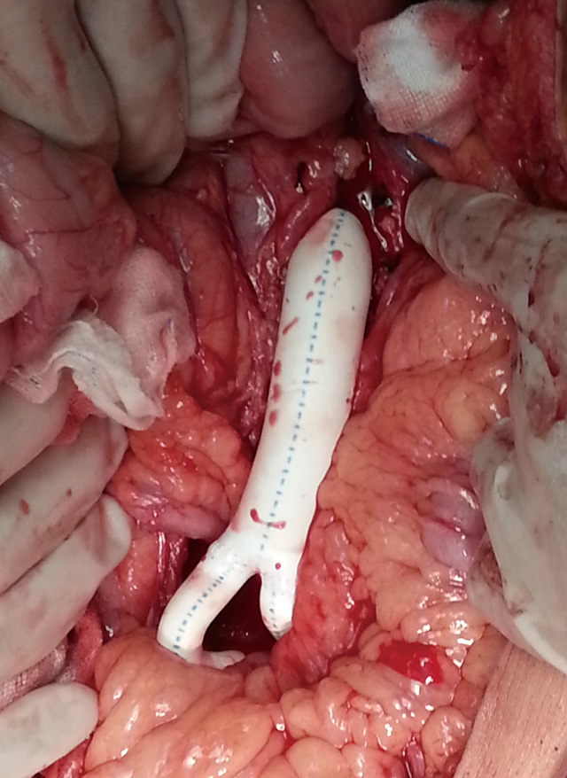 人造血管腹主動脈—雙髂動脈轉(zhuǎn)流術(shù)中