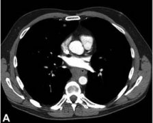 Barrett食管病怎么治療？