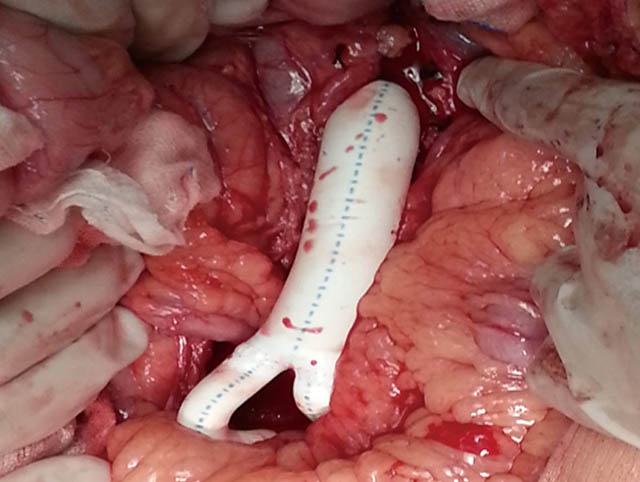 人工血管轉(zhuǎn)流術(shù)成功治療雙下肢動(dòng)脈硬化閉塞癥