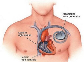 心臟起搏器植入術