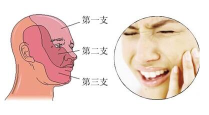 三叉神經(jīng)痛