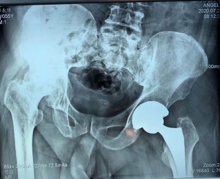 精于微創(chuàng)|山醫(yī)集團濰坊市市立醫(yī)院骨二科成功開展微創(chuàng)髖關節(jié)置換術