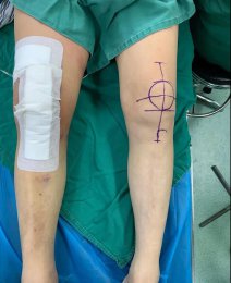 生命走向健康的音符——骨二科為老人成功實施全膝關節(jié)置換術